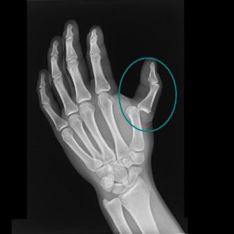 Thumb Dislocation X-ray